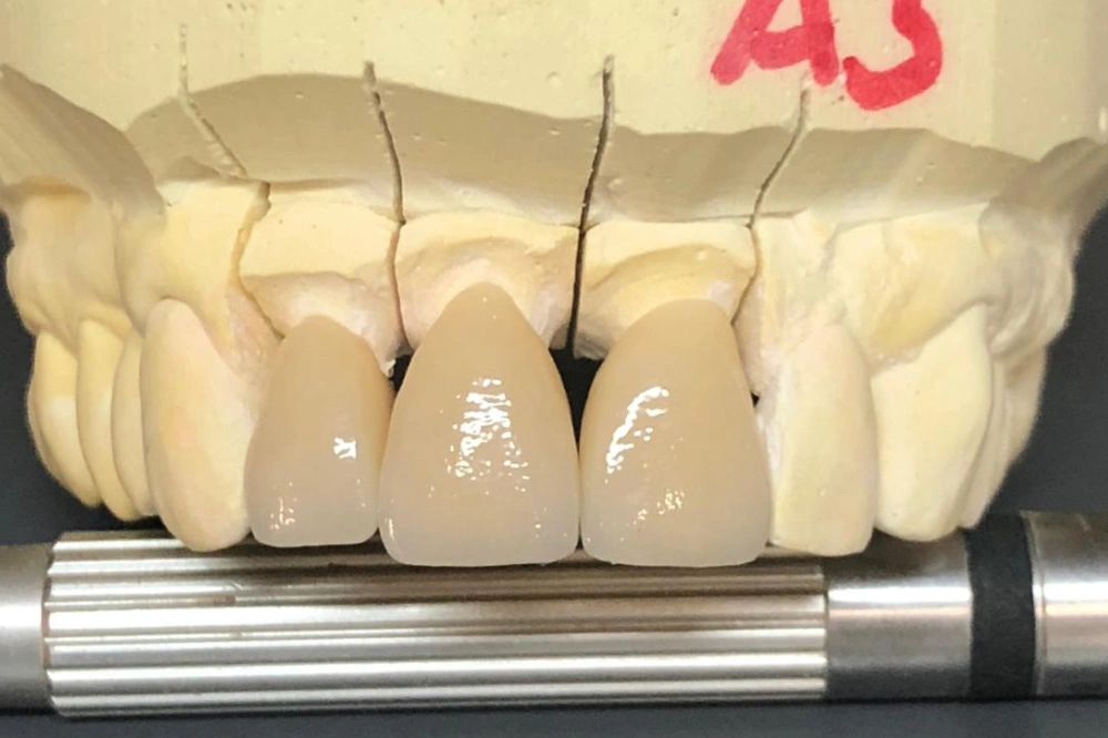Gebrochene Zahnprothese vor der Reparatur im Dentallabor in Wien