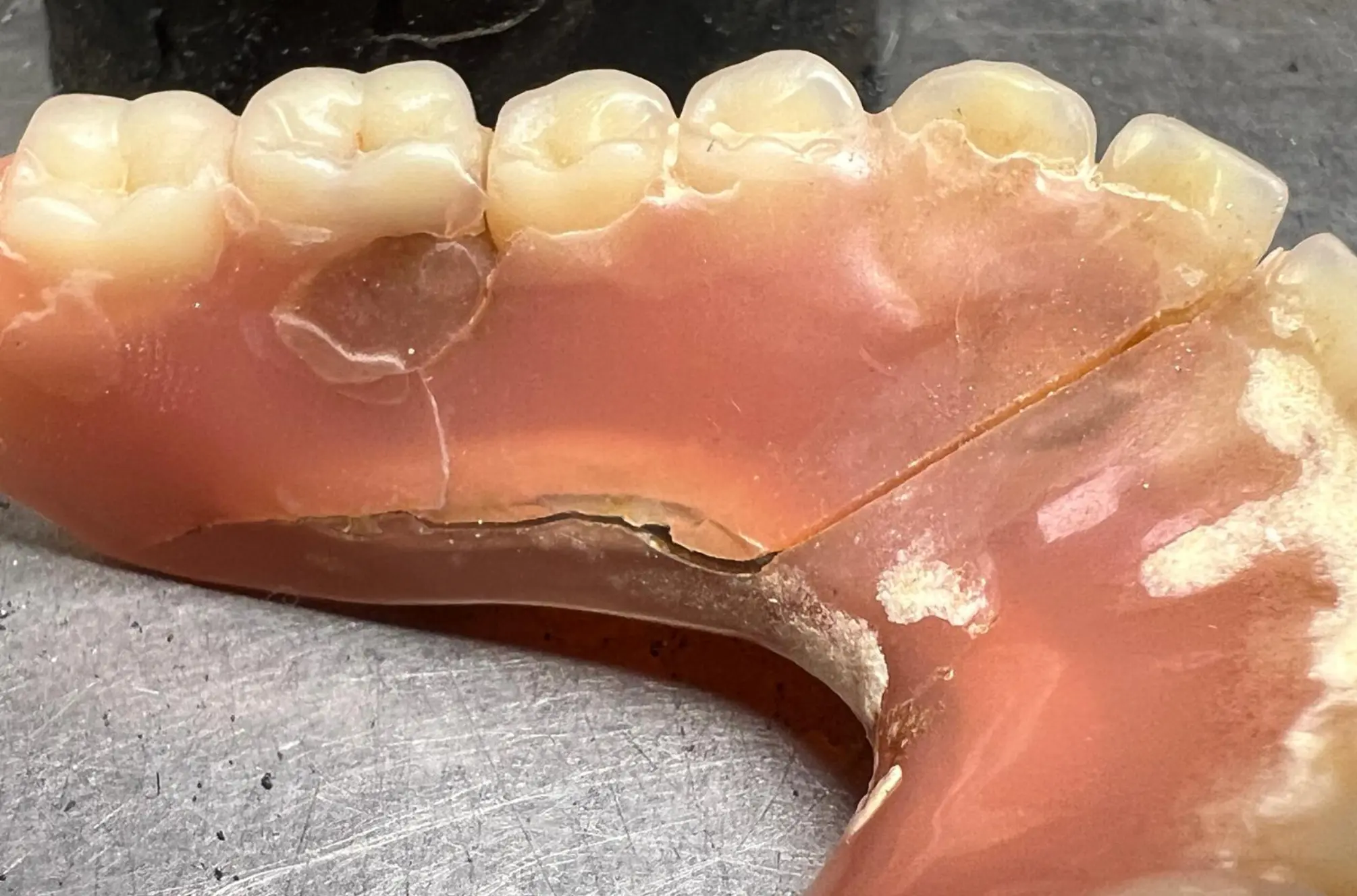 prothese in 1170 Wien erfolgrech repariert