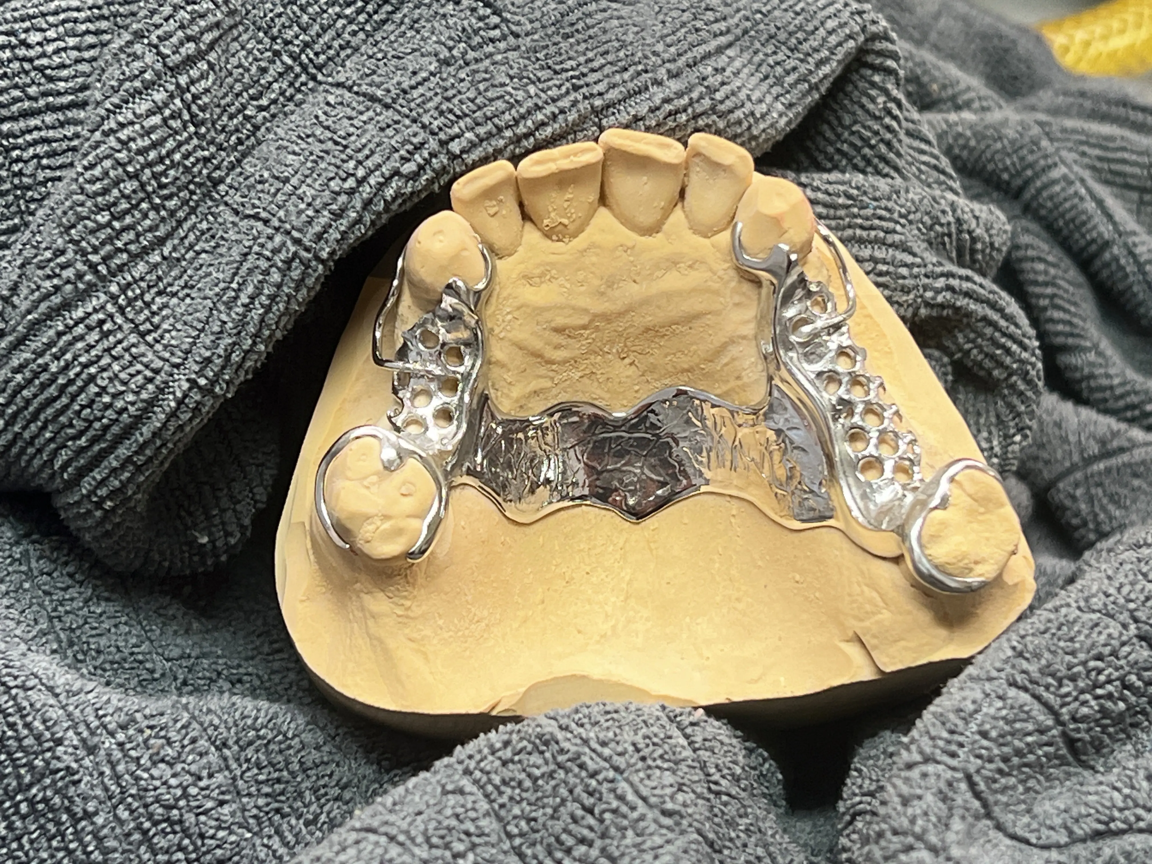 Meisterhafter Modellguss für Wiener Zahnlabore Ganger Dentaldesign