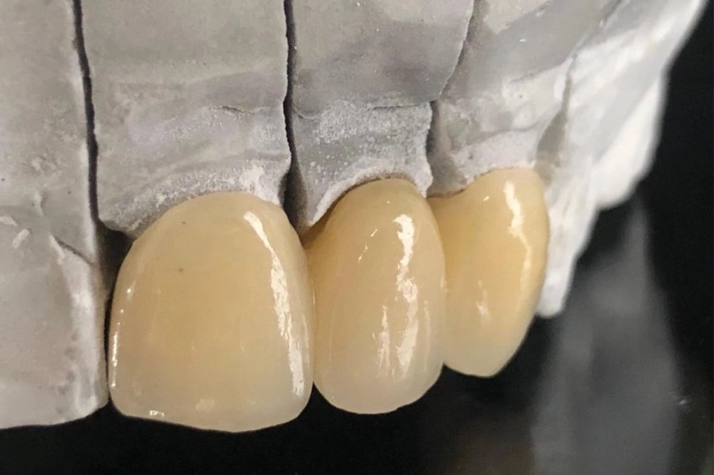 Dreigliedrige VMK Keramikbrücke aus dem Dentallabor in Wien